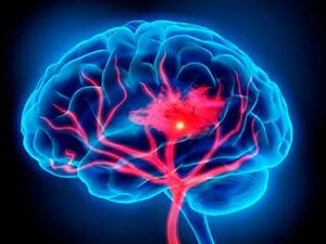 Benefícios do Método Pilates em Pacientes Portadores de Sequelas de  Acidente Vascular Cerebral (AVC'S +AVE'S ) – InterFISIO